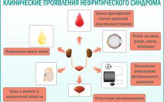 Нефритический нефротический и мочевой синдромы