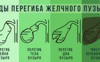 Болевые синдромы при перегибе желчного пузыря