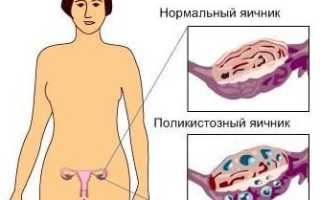 Синдром поликистозных яичников причины и лечение