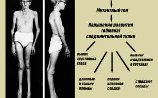 Синдром марфана прогноз для жизни