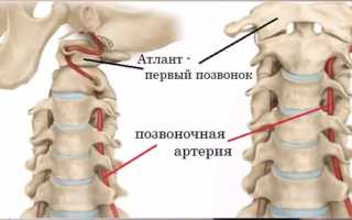 Остеопатия при синдроме позвоночной артерии
