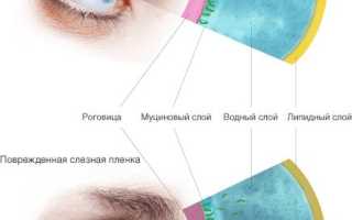Синдром сухого глаза у человека
