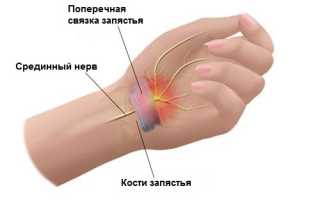 Туннельный синдром упражнения для рук