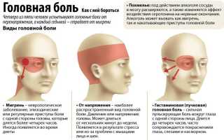 Синдром вегетативной дисфункции с цефалгиями