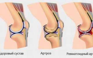 Код мкб недифференцированный артрит