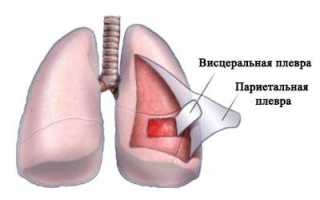 Синдром жидкости в плевральной полости это