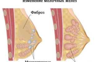 Мастопатия молочных желез код мкб