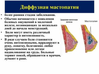 Мастопатия молочных желез код мкб