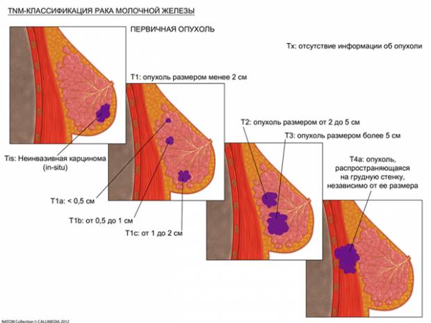 Классификация рака молочной железы тнт