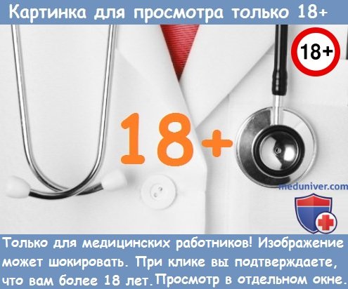 Опухоль околоушной слюнной железы