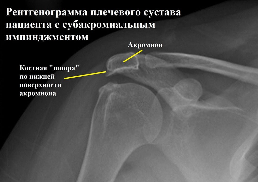 Импичмент синдром плечевого сустава операция