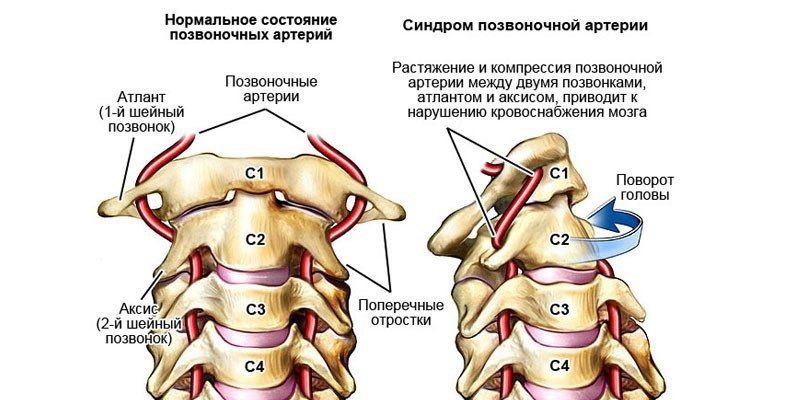 Нормальное состояние и синдрома сдавления позвоночной артерии