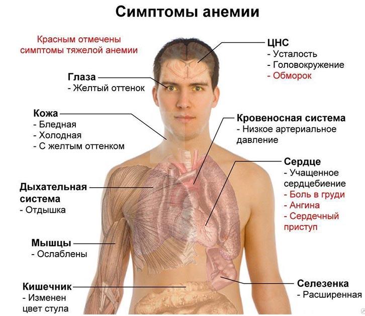 Анемия