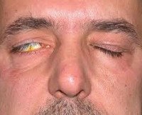 Лагофтальм