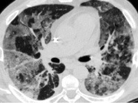 Интерстициальная пневмония