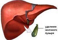 Постхолецистэктомический синдром