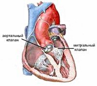 Митрально-аортальный порок