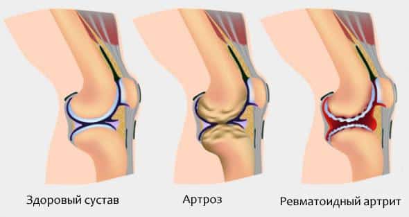 Что такое недифференцированный артрит