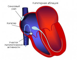 Экг синдром укороченного pq это