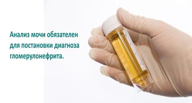 Анализы мочи при гломерулонефрите