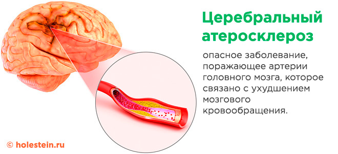 Атеросклероз церебральных сосудов
