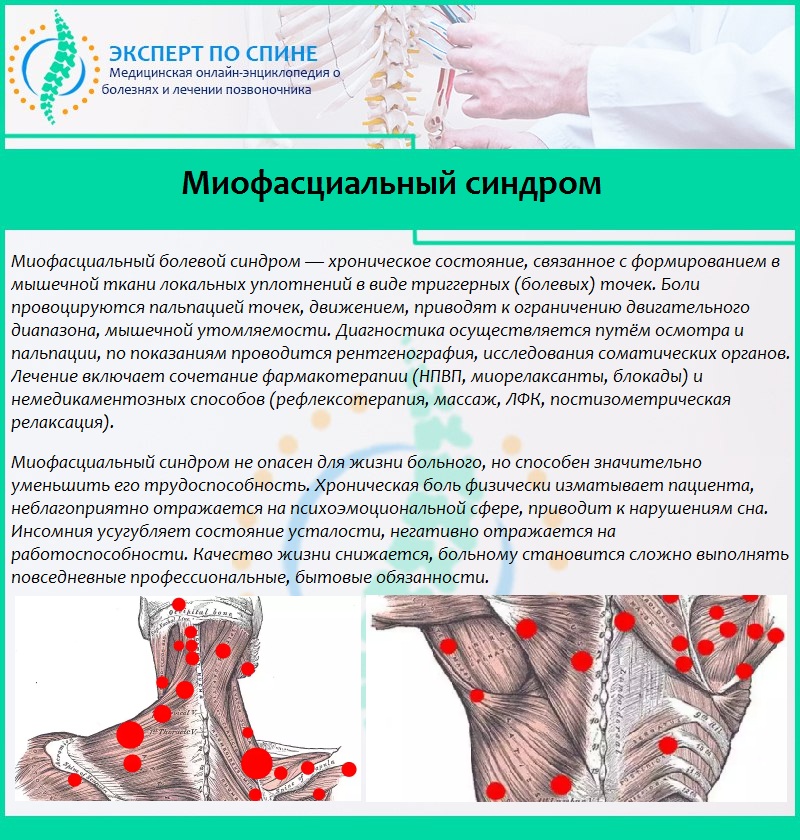 Миофасциальный синдром