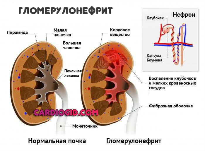 Гломерулонефрит