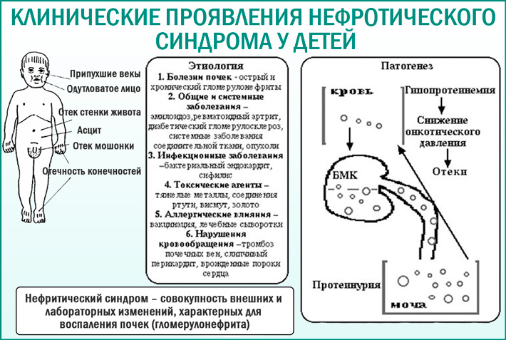 Нефротический синдром у детей: клинические проявления