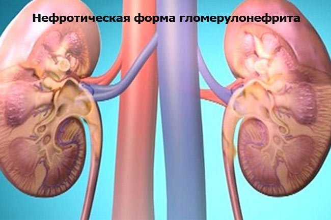 Нефротическая форма гломерулонефрита