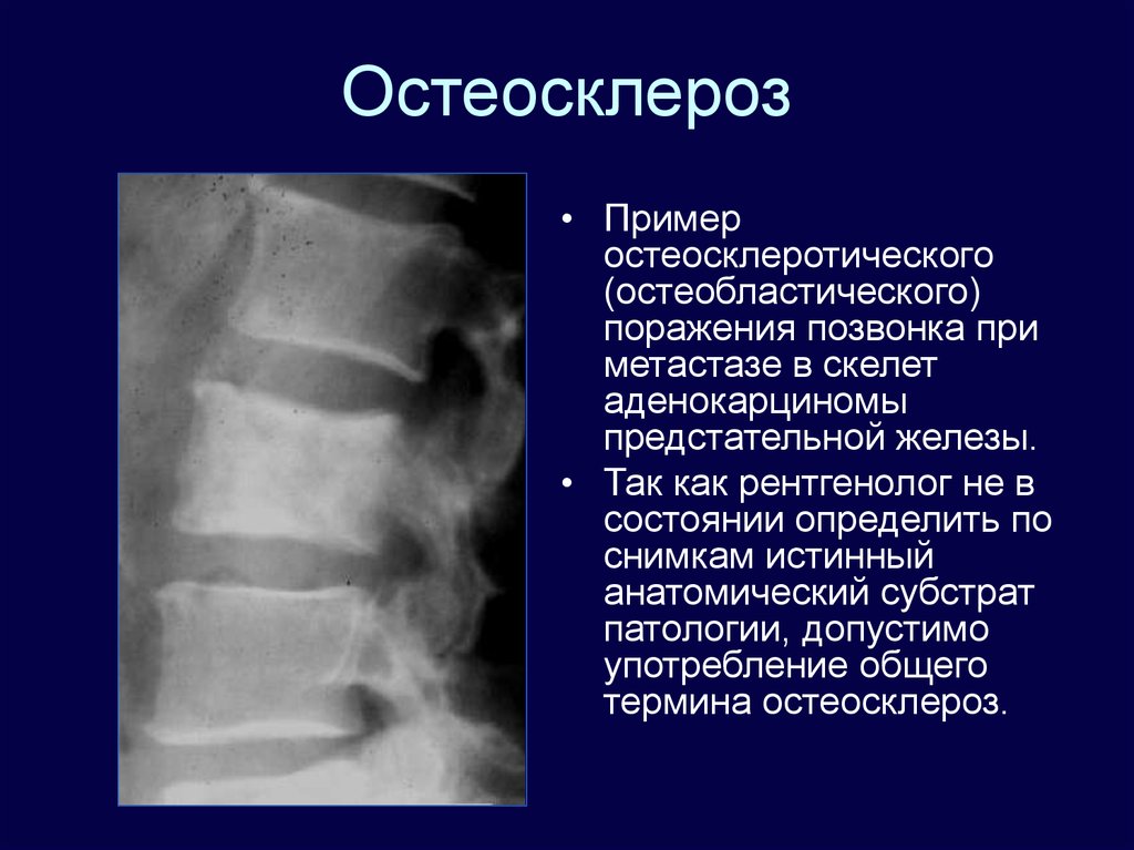 Остеосклероз