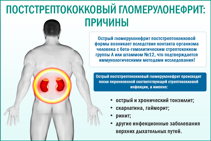 Острый постстрептококковый (постинфекционный) гломерулонефрит: причины
