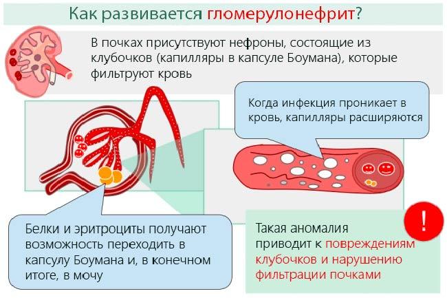 Причины гломерулонефрита