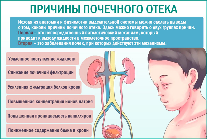 Почечные отеки. Причины