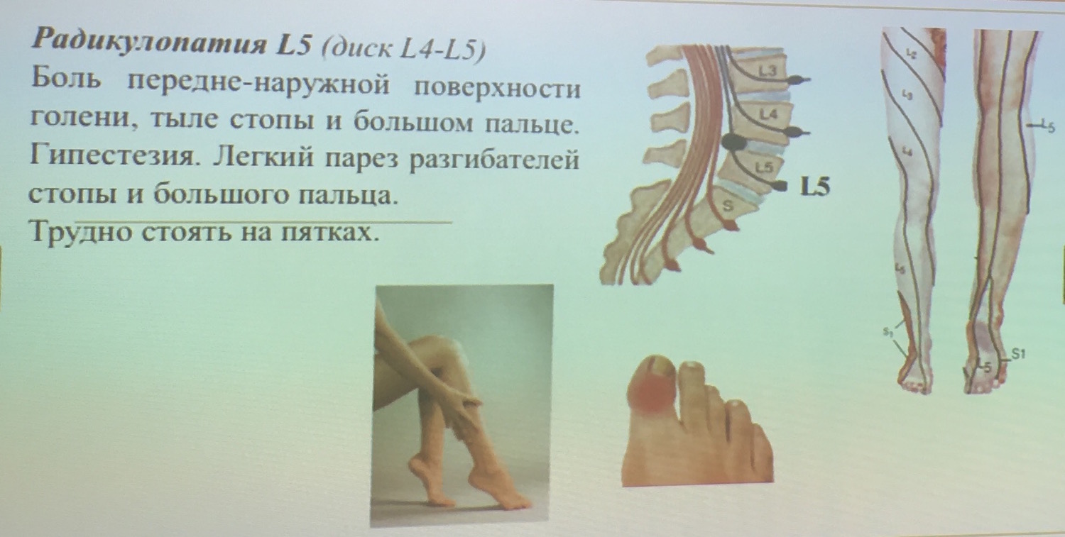 Радикулопатия
