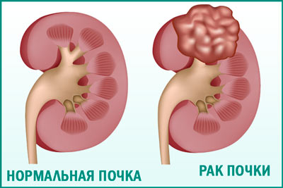 Рак почек: симптомы