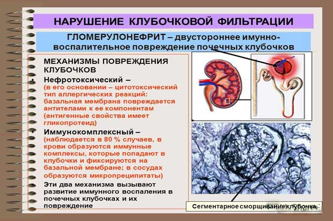Воспаление почечных клубочков