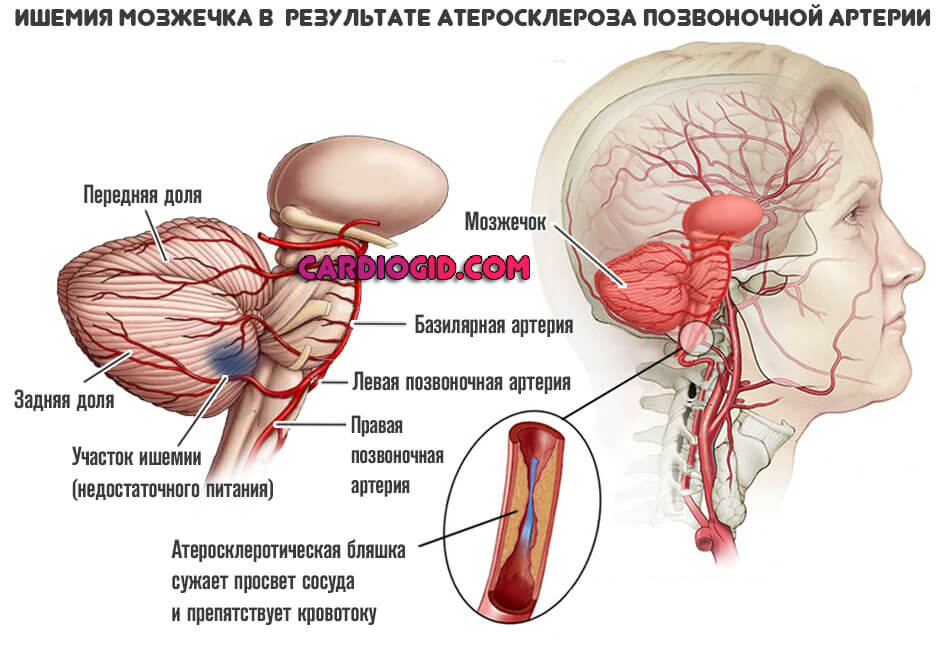 атеросклероз-церебральных-сосудов