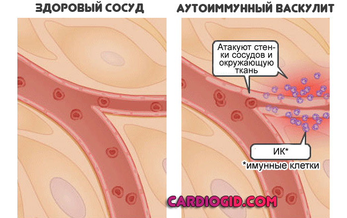 аутоммунный-васкулит