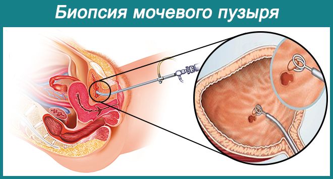 биопсия МП