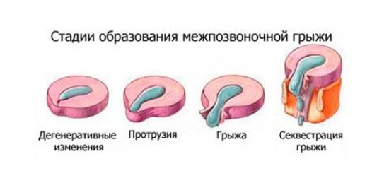 Стадии межпозвоночной грыжи
