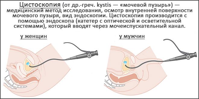 Цистоскопия мочевого пузыря