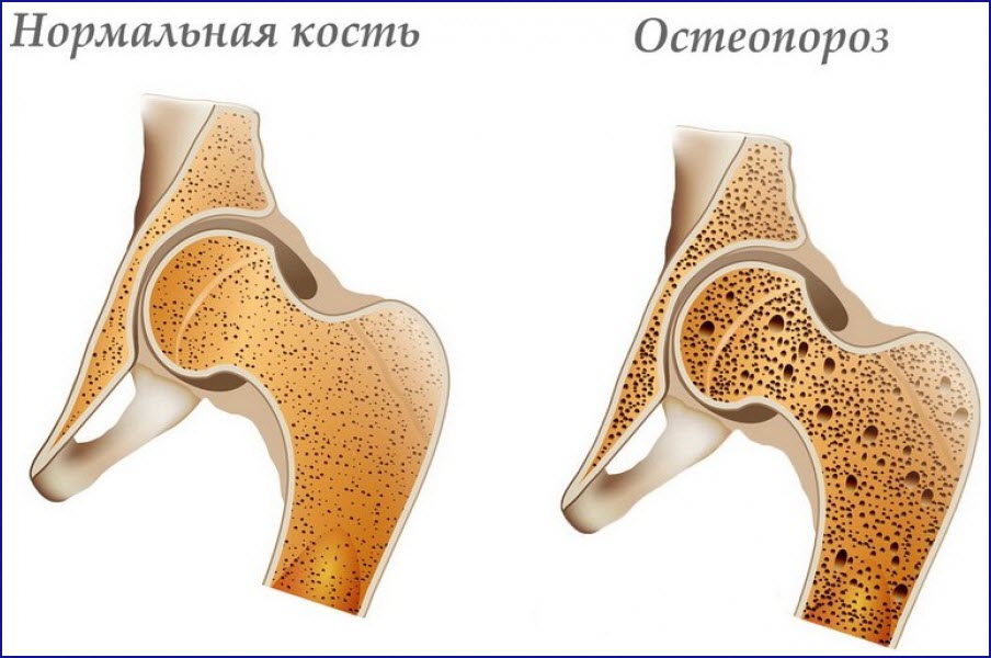 Остеопороз