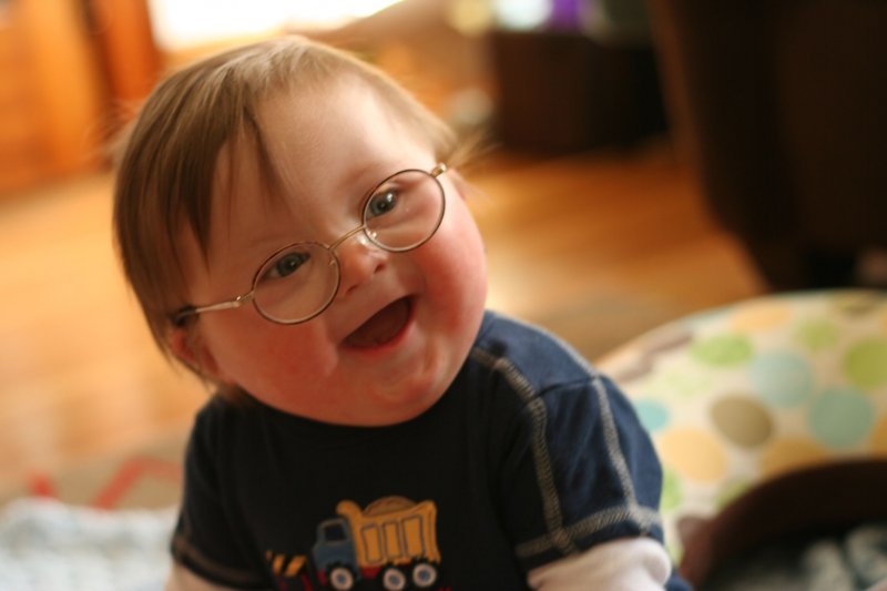 down-syndrome