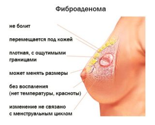 Мастопатия молочных желез код мкб