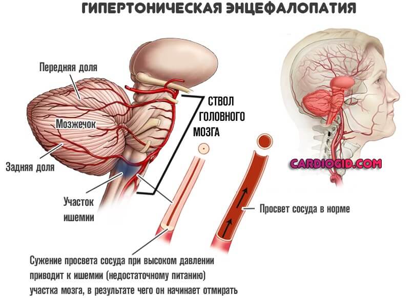 гипертензивная энцефалопатия