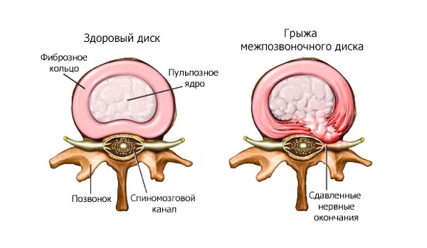 Сдавливание нервных окончаний при грыже диска позвоночника