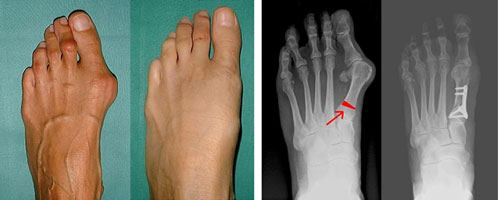 Результаты лечения при Hallux valgus