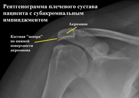 Рентген при импинджмент синдроме плеча