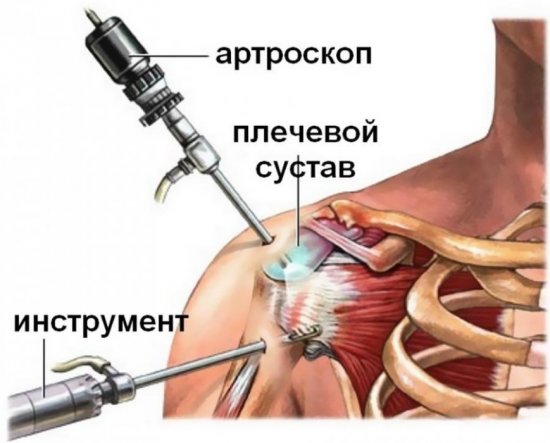 Артроскопия плечевого сустава