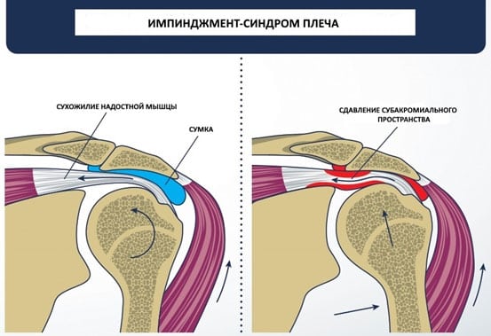Импичмент синдром плечевого сустава операция